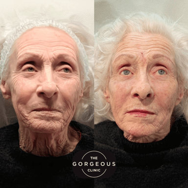 Before and immediately after non-surgical full face rejuvenation using advanced dermal filler and anti-wrinkle techniques to restore facial structure while preserving natural expression.
