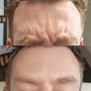 Before-and-after image of a man showing reduced forehead lines and softened glabella frown lines after wrinkle-relaxing injections.