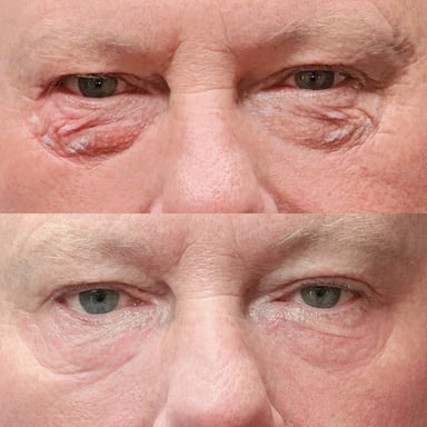 Before-and-after close-up of a man showing reduced under-eye puffiness and smoother lower eyelids after a fluid-retention reduction treatment.