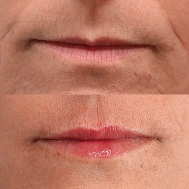 Before-and-after close-up of lips showing a subtle lift and smoother upper lip after a lip flip treatment.