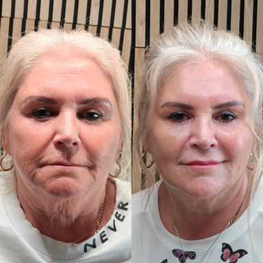 Before-and-after image of a woman showing full-face rejuvenation with lifted cheeks, smoother lower-face contours, refreshed lips, and improved neck texture.