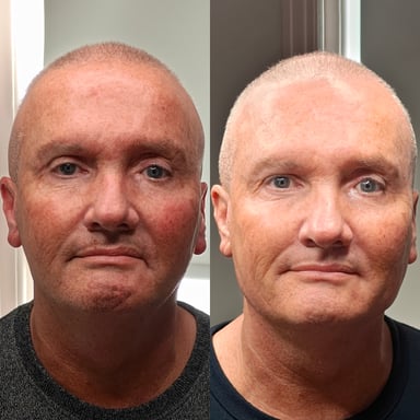 Before-and-after image of a man with facial asymmetry showing improved balance, smoother lines, and restored jawline definition after combined dermal filler and targeted muscle-relaxing treatment.