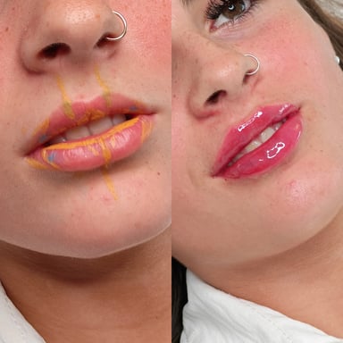 Side-by-side angled lip transformation showing pre-treatment mapping lines and post-treatment results with fuller, glossy, well-defined lips.