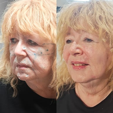 Before-and-after angled profile of a mature woman showing softened lines, lifted midface, improved jawline contour, and brighter overall expression after non-surgical facial rejuvenation.