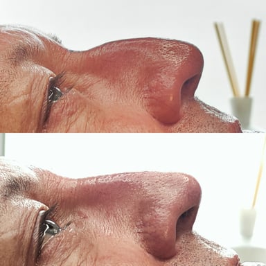 Before-and-after side profile of a man's nose showing a smoother, straighter bridge after non-surgical rhinoplasty.