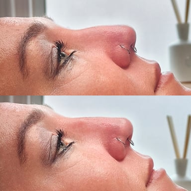 Before-and-after side profile of a young woman showing a smoother, lifted nasal bridge after non-surgical rhinoplasty.