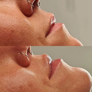 Before-and-after side profile of a woman’s lips showing a lifted, flatter Russian-style lip shape with minimal forward projection.