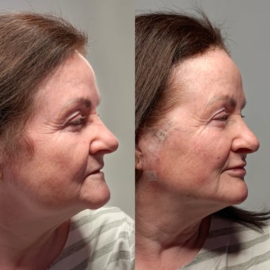 Before-and-after side profile of a woman showing improved lower-face support after thread lift, lip enhancement, DAO treatment, and pyriform fossa filler.