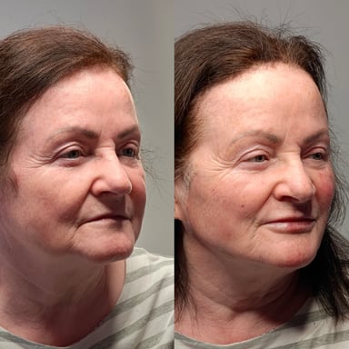 Before-and-after three-quarter view of a woman showing improved lower-face contour and support after thread lift, lip enhancement, DAO treatment, and pyriform fossa filler.