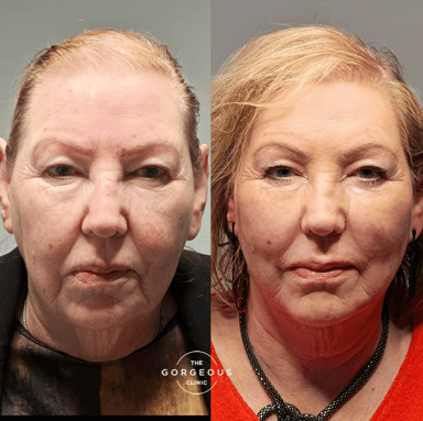 Before-and-after front view of a woman showing improved facial lift, softened mouth corners, and enhanced mid-face support after thread lift, pyriform filler, and DAO treatment.