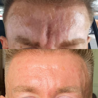 Before-and-after of a man’s forehead showing dramatic reduction of deep horizontal and vertical lines after collagen induction therapy, anti-wrinkle injections, deep chemical peel, and dermal filler.