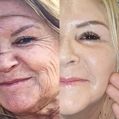Before-and-after of a woman showing smoother skin, reduced creasing, and brighter texture after collagen induction therapy and deep chemical peel.