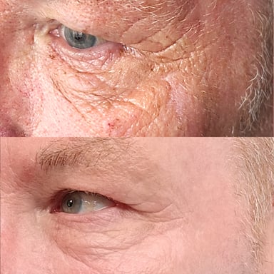 Before-and-after close-up of a man's under-eye and cheek area showing reduced wrinkles, smoother texture, and clearer skin after collagen induction therapy and a deep chemical peel.
