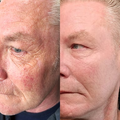 Before-and-after image of a mature man's full face showing dramatically improved tone, smoother texture, reduced sun damage, and clearer, healthier-looking skin after CIT and a deep chemical peel.