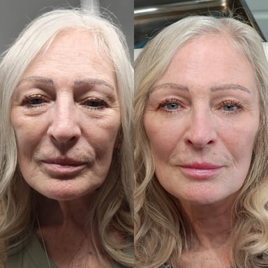 Before-and-after image of an older woman showing a full non-surgical facial rejuvenation with improved volume, smoother contours, reduced shadows, and a lifted, refreshed appearance.