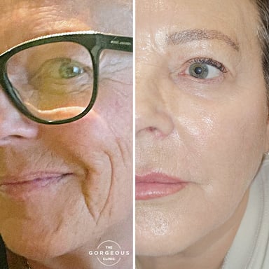 Before-and-after close-up of an older woman showing dramatic improvement in deep facial folds, skin texture, brightness, and overall facial rejuvenation after full-face dermal filler and advanced skin resurfacing.