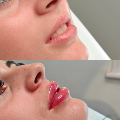Before-and-after side view of lip enhancement showing subtle, natural volume increase and improved lip contour with a glossy, hydrated finish.
