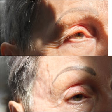 Before-and-after close-up of an older woman’s temple and eye area showing restored volume, smoother contours, and improved facial balance after temple filler.