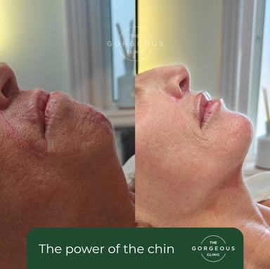 Before and after side-profile view showing natural chin projection enhancement using dermal filler and anti-wrinkle treatment to improve facial balance and profile harmony.