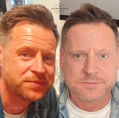 Before and after male anti-wrinkle treatment showing softened forehead and eye-area lines with natural, masculine results.