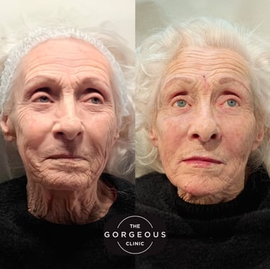 Before and immediately after non-surgical full face rejuvenation using advanced dermal filler and anti-wrinkle techniques to restore facial structure while preserving natural expression.