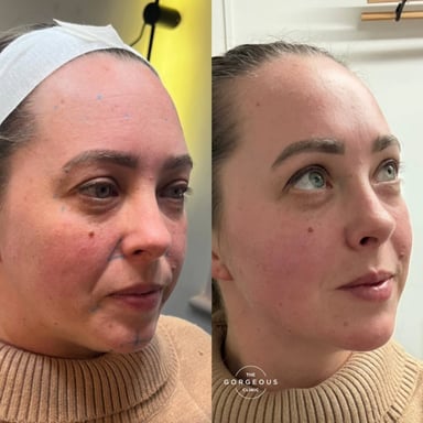 Before and after showing a natural facial refresh using subtle dermal filler and anti-wrinkle injections to improve balance and create a rested appearance.