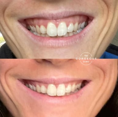 Before and after showing conservative gummy smile correction using staged anti-wrinkle injections to gently reduce excessive gum show.