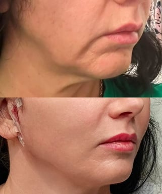 Before and after showing a bespoke thread lift to the jowl area using premium Korean PDO threads for natural facial lifting.