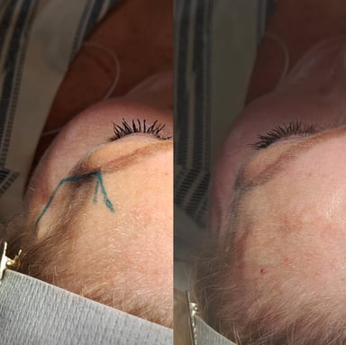 Overhead before and after showing temple filler re-volumisation to restore upper facial balance and soften temple hollowing.