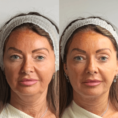 Front-on before and after showing a mid and lower face thread lift reducing jowls and restoring a fresher, lifted appearance.