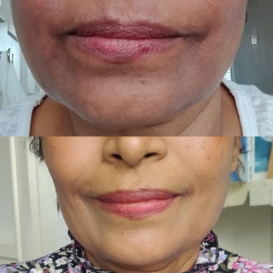 A powerful depigmentation peel used to safely restore brightness and even skin tone following pigmentation changes caused by medical treatment.