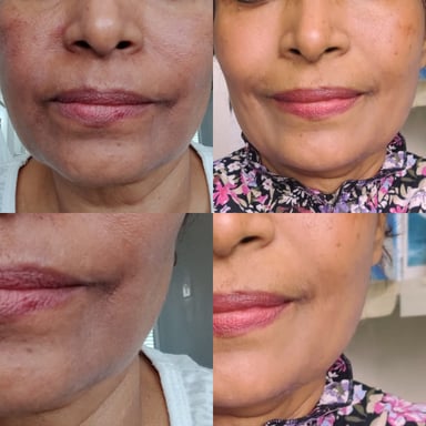 Multiple angle before and after images showing improvement in perioral hyperpigmentation after a deep depigmentation peel