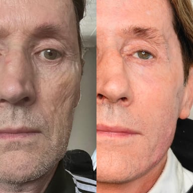 Before and after images of a male patient showing full facial reconstruction using dermal filler, skin treatments, and collagen stimulation