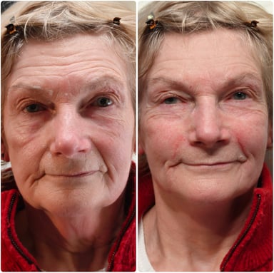 Before and after full-face rejuvenation showing softer under-eye bags, smoother nasolabial folds, and a fresher, lifted expression