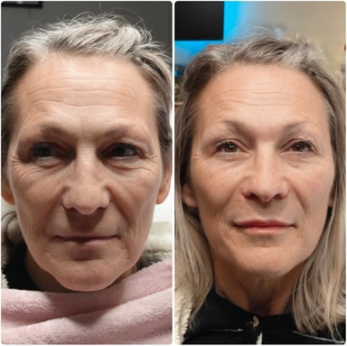 Before and after full-face rejuvenation showing restored cheek volume, softer under-eyes, smoother lines, and a fresher natural facial structure