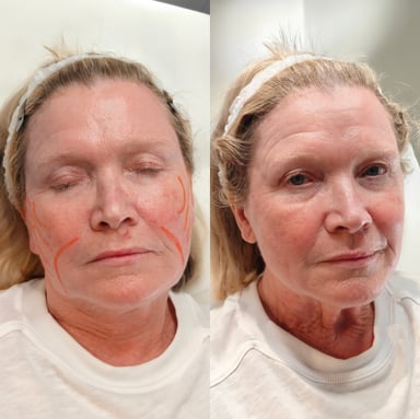 Before and after non-surgical thread lift showing subtle lifting through the jowls and lower face with a natural refreshed result