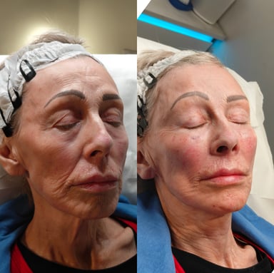 Before and after full-face rejuvenation showing restored volume, softer facial lines, and a natural lifted result following advanced non-surgical treatment