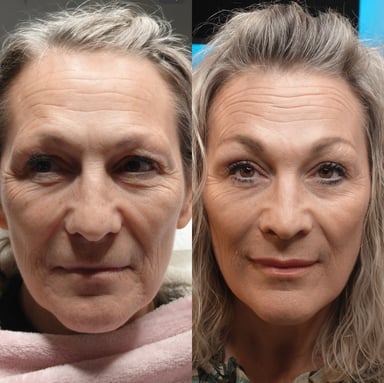 Before and after full-face rejuvenation showing the settled two-week result with natural lip enhancement, softer lines, and a fresher youthful appearance