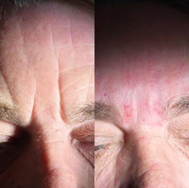Before and after advanced glabella filler treatment showing significant softening of deep static frown lines