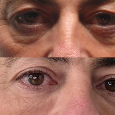 Before and after advanced under-eye rejuvenation showing smoother orbital rim support and a brighter more rested eye area