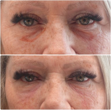 Before and after advanced under-eye correction showing smoother medial orbital rim support after dissolving previous filler