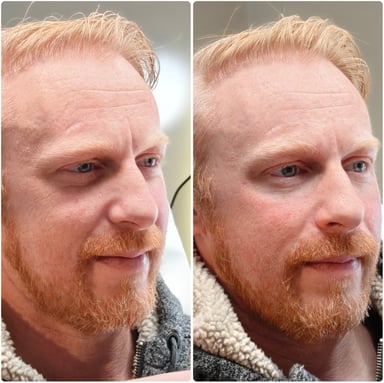 Before and after nasolabial fold treatment showing softer nose to mouth lines and natural facial movement following advanced piriform support