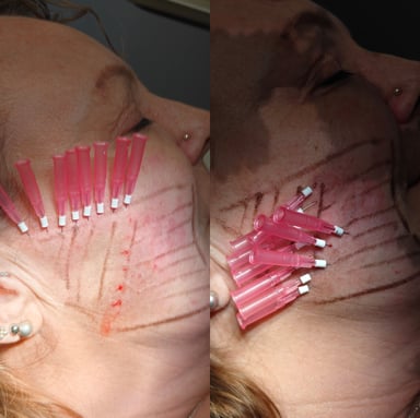 PDO tightening threads being placed into the lower cheek and chin to improve crepey skin, tighten laxity, and refine the lower face contour