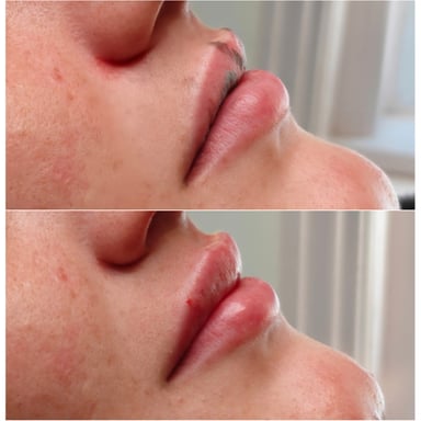 Side-profile before-and-after of a woman showing subtle lip filler enhancement with natural fullness and balanced shape.