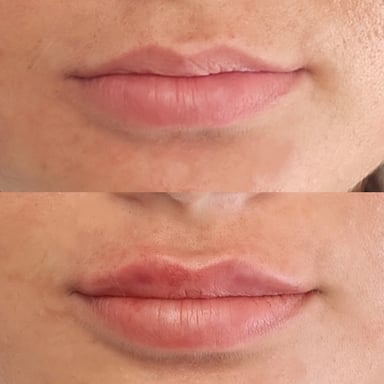 Before-and-after image showing subtle lip filler used to refine a natural M-shape and create soft, balanced volume.