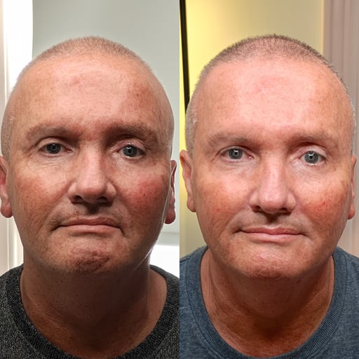When it comes to Anti-wrinkle injections, the skill, experience and artistic ability of the practitioner makes a huge difference on the outcome. We use THE STRONGEST licensed product on the market, for the longest lasting results.

Here at The Gorgeous Clinic, we're  Anti-Wrinkle experts. we analyse your facial muscles, rather than simply following a template. 

This way, we can treat the exact areas needed to produce the most flawless result. This is how we've built such a fantastic reputation in this field as a clinic.

**We must carry out a free, face-to-face consultation before booking in your first treatment**