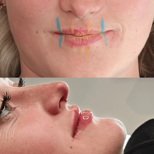 Advanced Lip Enhancement pairs dermal filler with strategic muscle relaxation to create smoother integration, a more refined lip border, and a beautifully natural finish. 

By relaxing the surrounding muscles, the filler settles more harmoniously into the tissue, allowing collagen to stabilise the shape before the B’tox wears off.