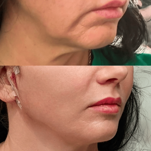 Experience a revitalized appearance with the PDO Cog Thread Lift, a non-surgical procedure designed to gently lift and smooth your skin, revealing a natural-looking youthfulness. 

Ideal for those who seek subtle, natural enhancements without undergoing surgery, the PDO Thread Lift offers a delightful secret to maintaining your inherent beauty and ensuring it radiantly shines through in every moment of life. 

Illuminate your presence with a gentle lift and let the world see your vibrancy in its full splendor, effortlessly and elegantly. 