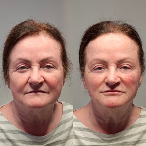 How much does a thread lift cost, especially in the UK, where discerning clients seek quality and value? 

At The Gorgeous Clinic, we transparently navigate you through our pricing, ensuring your journey towards a delicately refreshed visage is clear and straightforward. We charge by skill, not per thread.