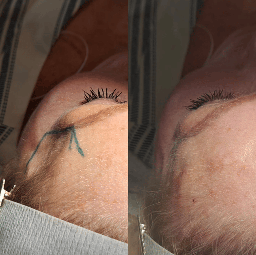 As we age, loss of volume in the temples, brow bone, and forehead can lead to a hollowed, tired appearance. 

We focus on restoring that lost volume using dermal filler, giving you a refreshed, more youthful look. 
